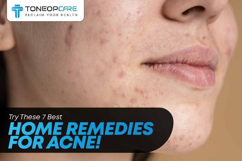 Try These 7 Best Home Remedies For Acne! | ToneOpCare